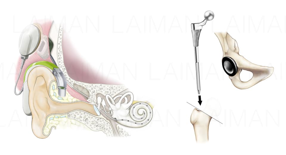 右：遺伝的背景から見た人工内耳についての研究論文イラスト／左：大腿骨全置換術手術手技イラスト